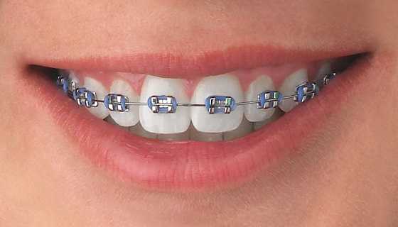metal braces