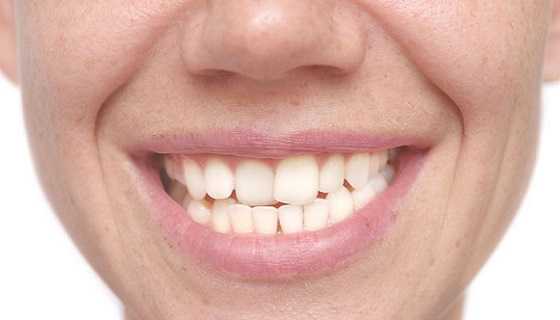 Misaligned teeths