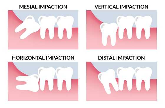 Various types of Impacted teeth