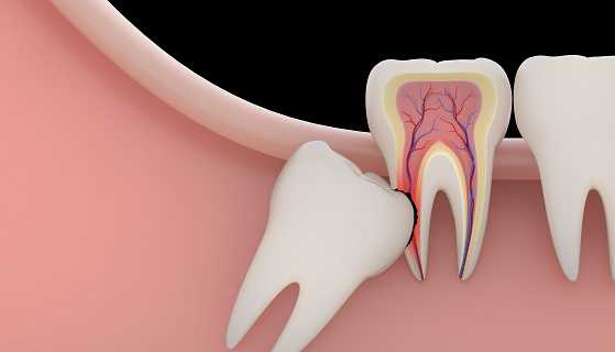 What does impacted tooth mean