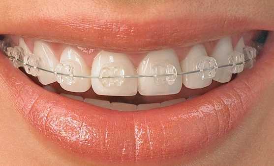 ceramic braces