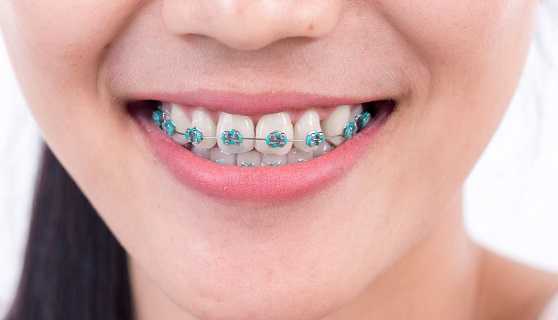 Ceramic teeth braces cost in India