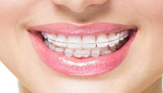 straighten teeth with braces