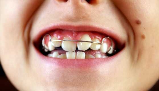 Treatment with braces Treatment with braces