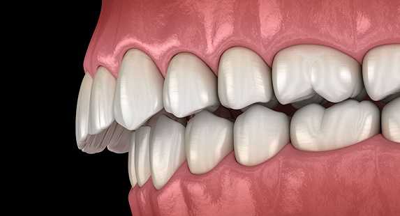 What Is the Difference between an Overbite and an Overjet?