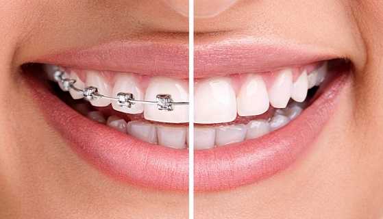 braces treatment budget for Orthodontic treatment