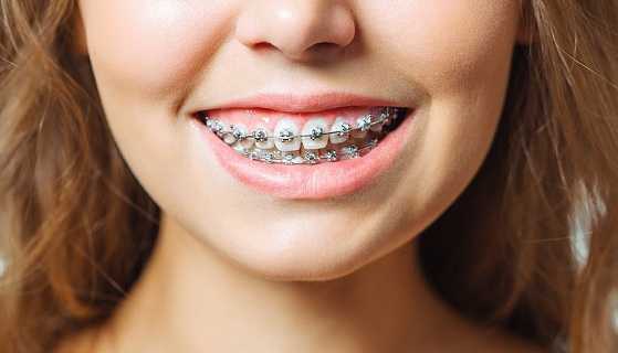 Metal Braces Treatment