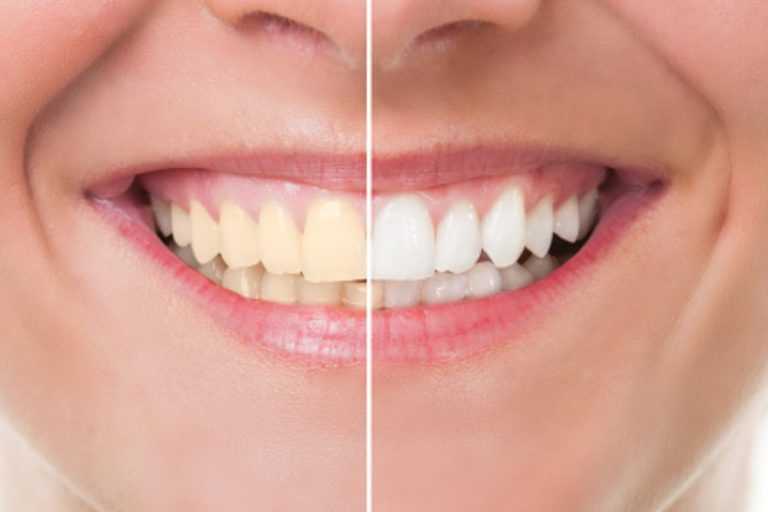 Reasons-lead-to-teeth-staining
