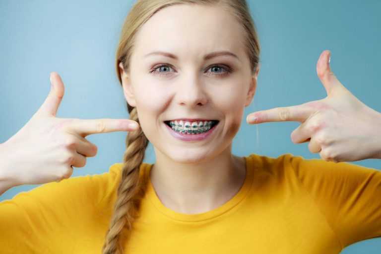 These-common-braces-myths-