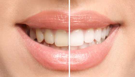 teeth whitening teeth whitening