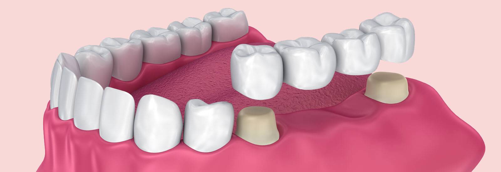 Dental Bridge Cost Near Me Tooth Bridge Treatment In India