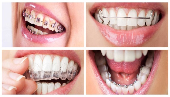 Different types of braces