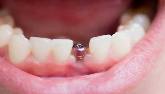 fix gaps in teeth