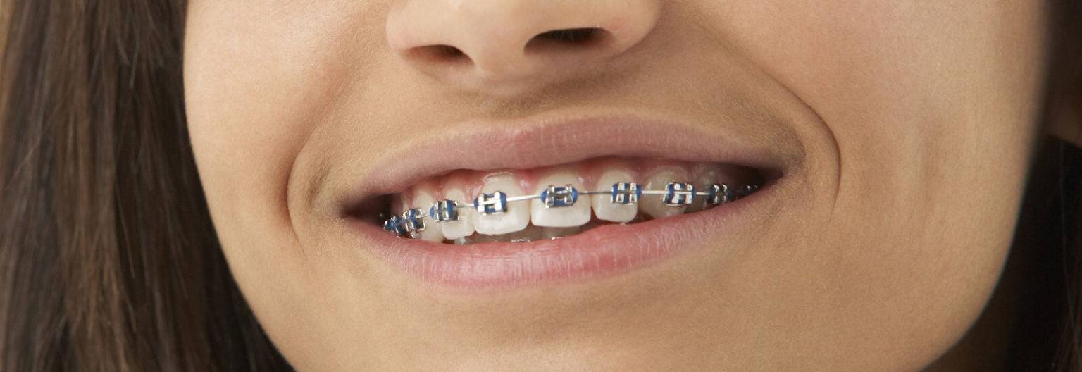 Best Orthodontist Near Me Affordable Orthodontic Treatment Cost 