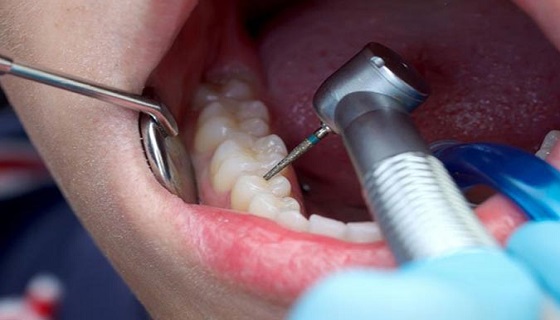  root canal treatment