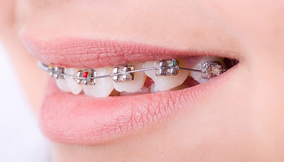 treat crooked teeth with braces