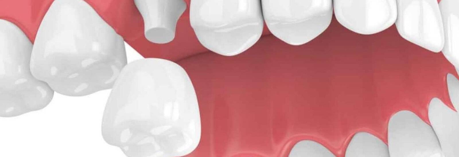 Dental Crown Cost In Bangalore Near Me Tooth Cap Cost In Bangalore