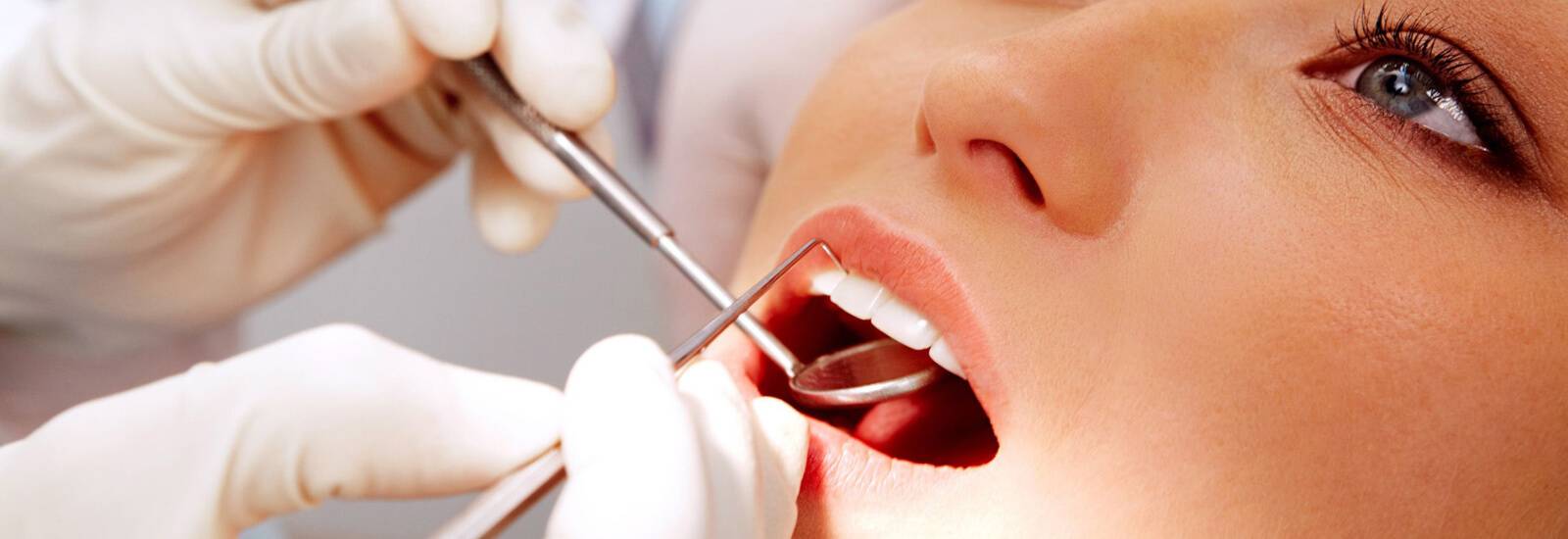 Dental-Fillings