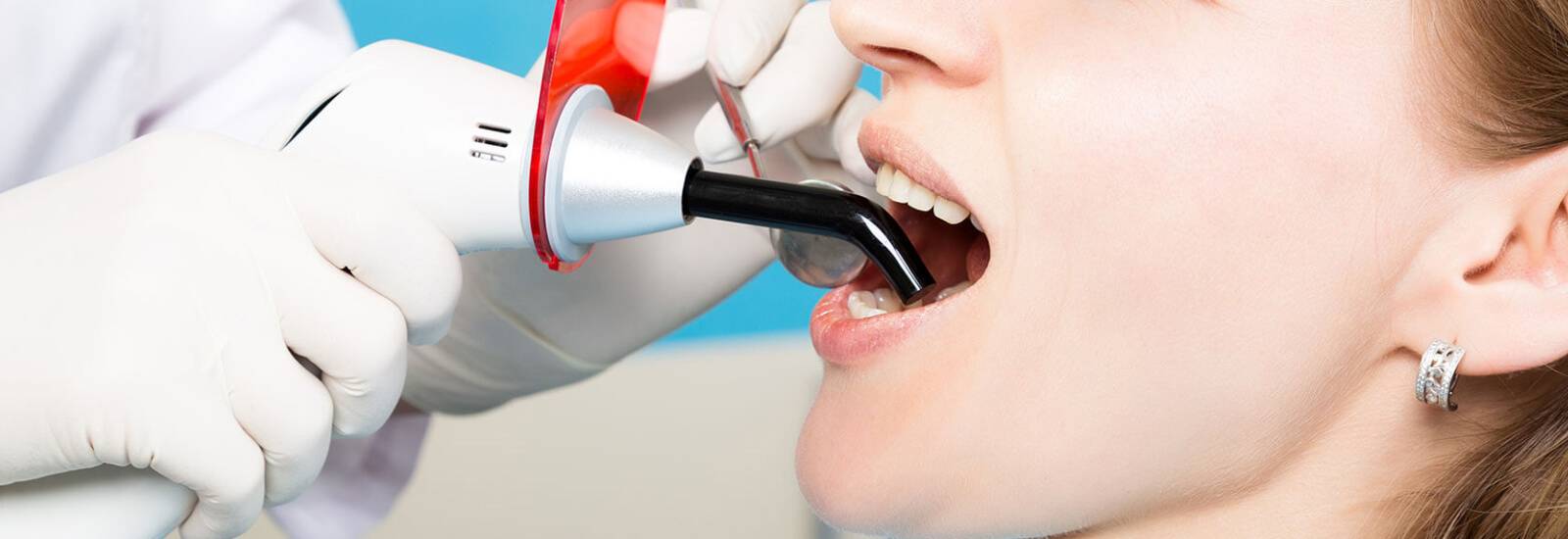 Dental Sealants Treatment