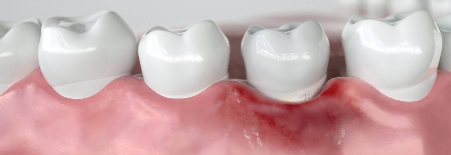 Best Gingivitis Treatment Near Me Best Gingivitis Cure In India