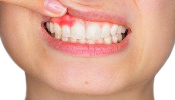 Gum Swelling