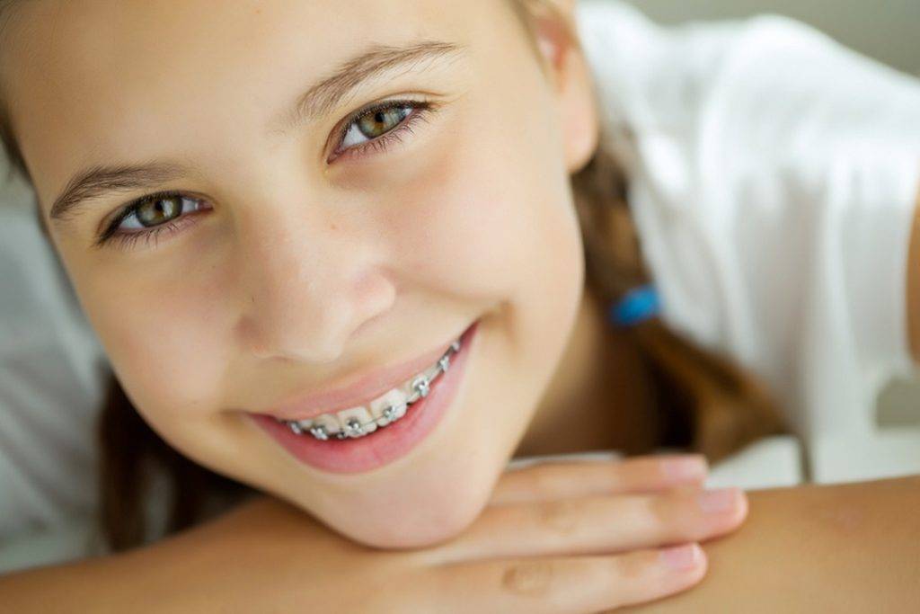 Oral care to take after Braces Removal