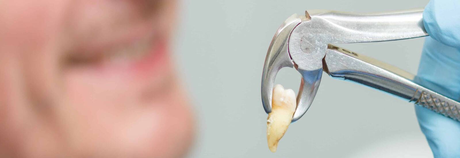 Tooth-Extraction-Procedure