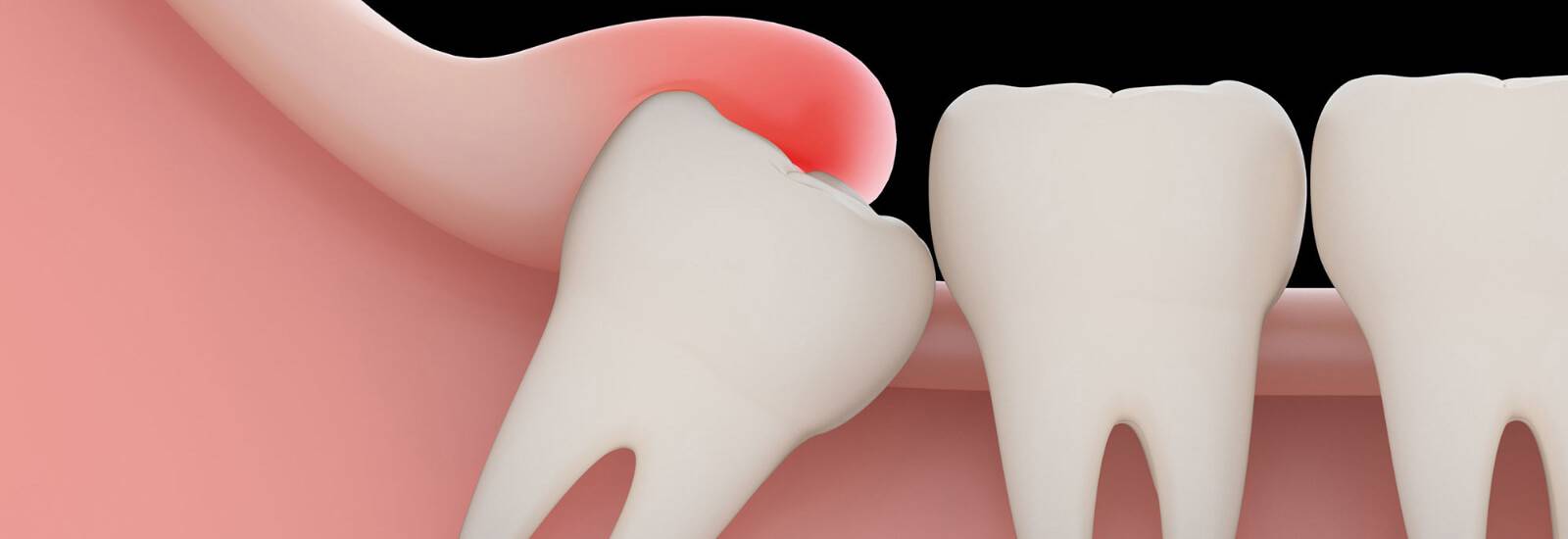 Wisdom-Tooth-Extraction