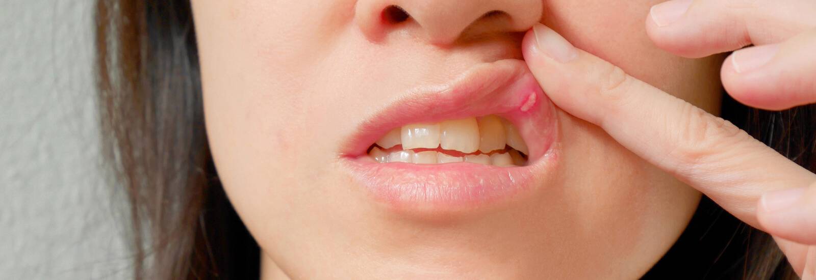 toothpaste to avoid with mouth ulcers