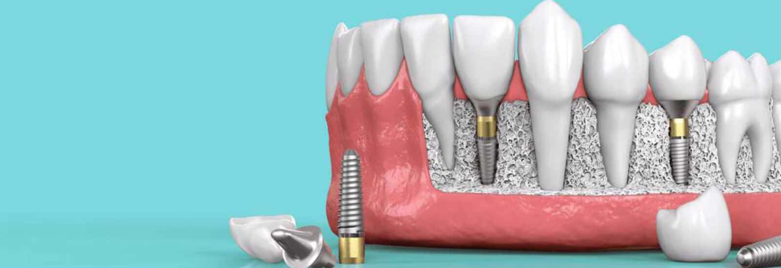dental implants in Mumbai
