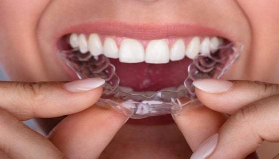 retainer-for-teeth retainer-for-teeth