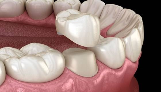 dental crown treatment