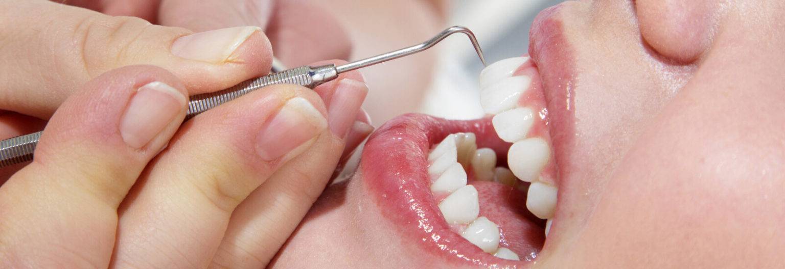 Best Teeth Cleaning In Mumbai | Affordable Teeth Cleaning ...
