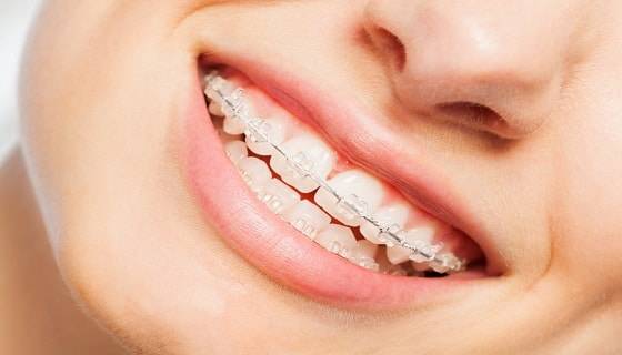 Ceramic Braces Ceramic Braces