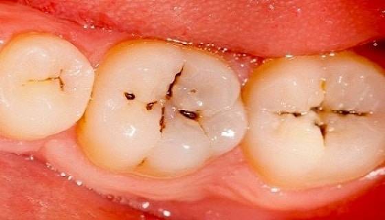 Decay in teeth