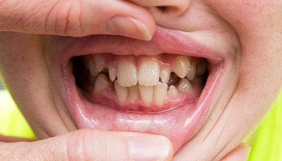 Protruding teeth
