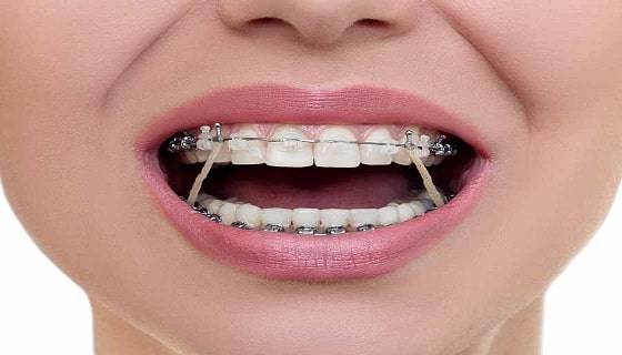 Teeth bands