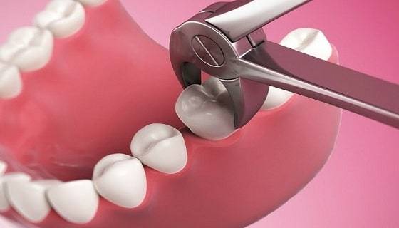 Tooth-Extractions Tooth Extractions
