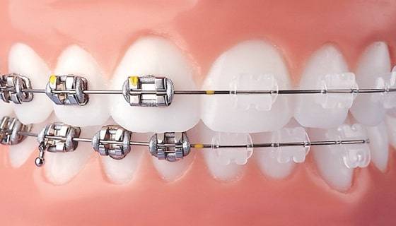 components are needed for braces