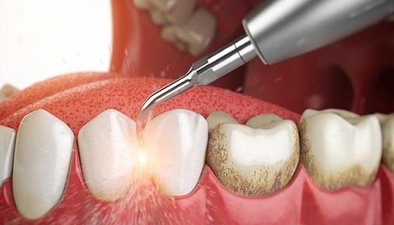 removing dental plaque