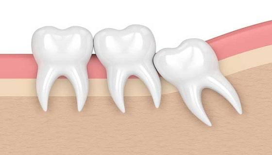wisdom teeth extraction wisdom teeth extraction