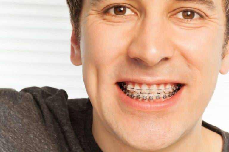 Treatment for the Teeth Gap with Braces