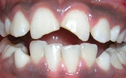 Chipped or Broken Tooth