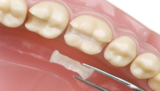 Dental sealants treatment
