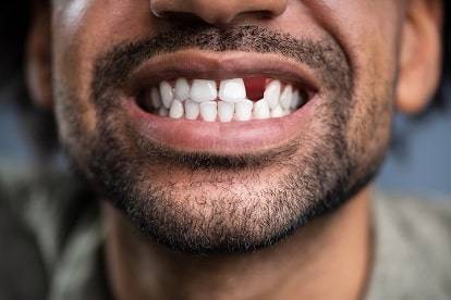 Missing Teeth Treatment