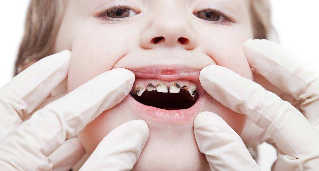 Tooth Decay Treatment