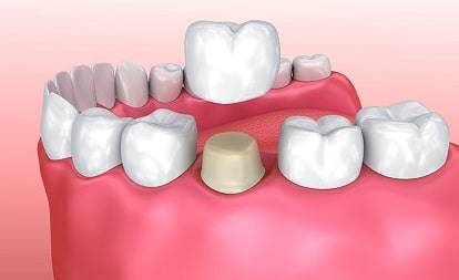 crown-bridges