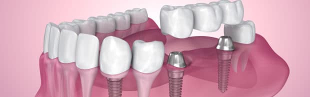 Dental Bridges