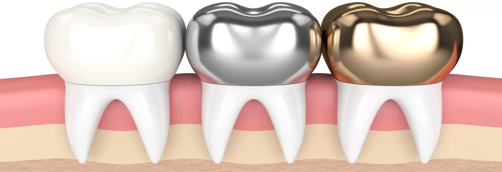 dental crown types