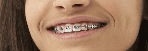 Orthodontic Treatment - Braces